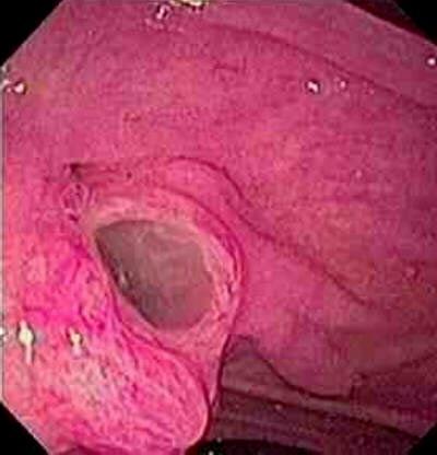 these tumors can become malignant in approximately a third of patients. These tumors can invade nearby structures such as the duodenum, stomach and bile duct [6].