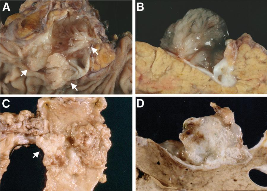 HEPATOLOGY, Vol. 44, No. 5, 2006 ZEN ET AL. 1335 Fig. 1. Macroscopic pictures of biliary papillary tumors.