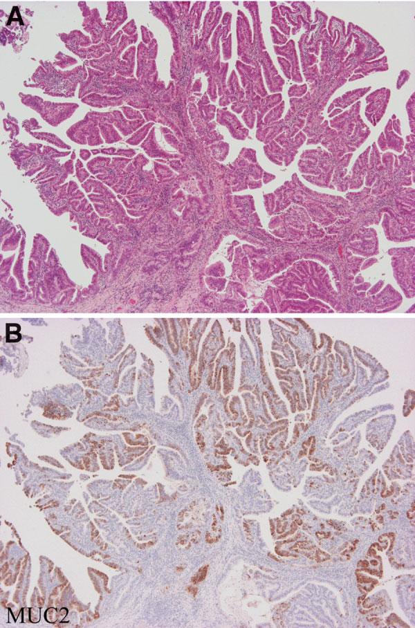 In contrast, all non-papillary-cc cases were of the pancreaticobiliary type, and intestinal and gastric types were not observed in any cases of non-papillary-cc. Expression of MUC1, MUC2 and MUC5AC.