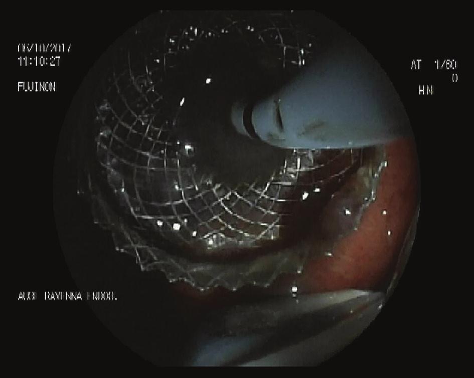 (ERCP) is not feasible. LAMS have an increasing role in the setting of choledochoduodenostomy (CDS) and gallbladder drainage (GBD). CDS Figure 2 Endoscopic ultrasound image (7.