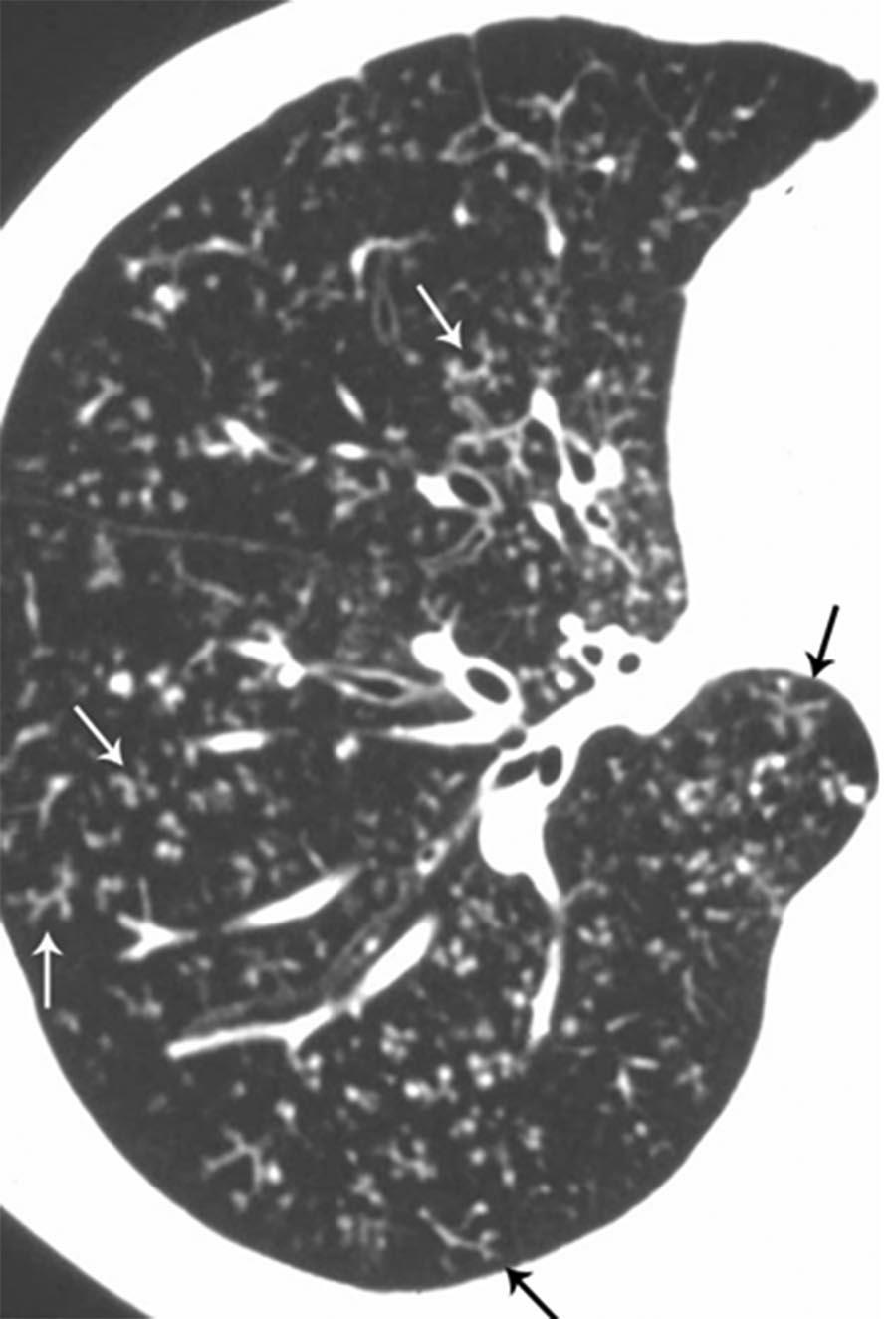 Ground-glass nodules with prominent tree-in-bud opacities Appearance of an irregular and often nodular branching structure, most easily identified in the lung periphery Represents