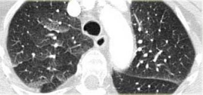 Ground-Glass Opacity Hazy increase in lung opacity without obscuration of underlying vessels Increase in lung density is due filling of alveolar spaces with pus, edema, hemorrhage, inflammation, or