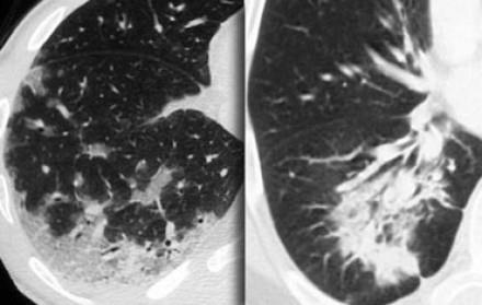 Consolidation Hazy increase in lung opacity with obscuration of underlying vessels Pneumonia PJP, viral, bacterial, Mycoplasma Eosinophilic pneumonia