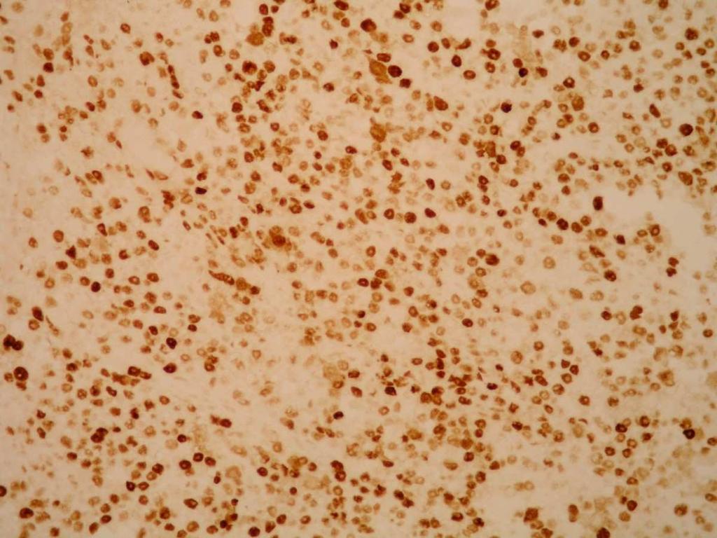 Uzorak tkiva parotide dobiven biopsijom. Strelica na slici pokazuje vidljivu pozitivnu reakcija na p 53, koja diferencijalno-dijagnostički ukazuje na epiteloidni MPNST. Picture 5.