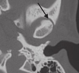 CT of the TMJ Fig. 9. Osteorthritis. Axil CT imge () shows mild osteorthritis, with joint spce nrrowing nterolterlly (rrow), the usul site of erly chnges.