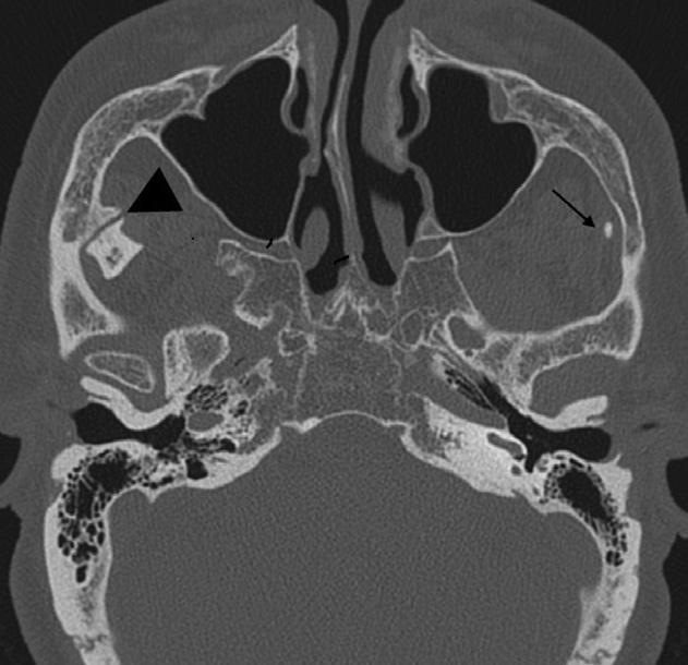 the end of puerty. Fig. 10. Intr-rticulr nkylosis. Coronl reformtted CT showing ony nkylosis on the right nd likely firous nkylosis on the left.