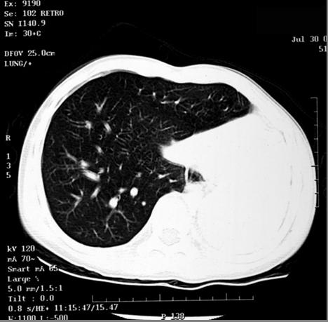Post-Op Chest CT: Lung Window Left lung is absent. Right lung is clear.