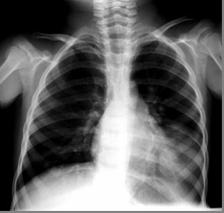 Chest X-Ray from Outside Hospital, 1996 PA View Lateral View Opacity Round