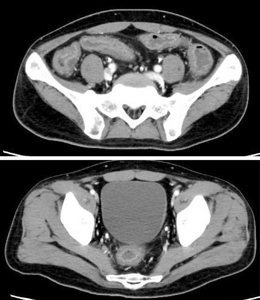 revealed irregular shallow ulcers and verrucous erosions from the sigmoid colon to the rectum, and extensive offwhite exudate adhered to the mucosa (Fig. 2).