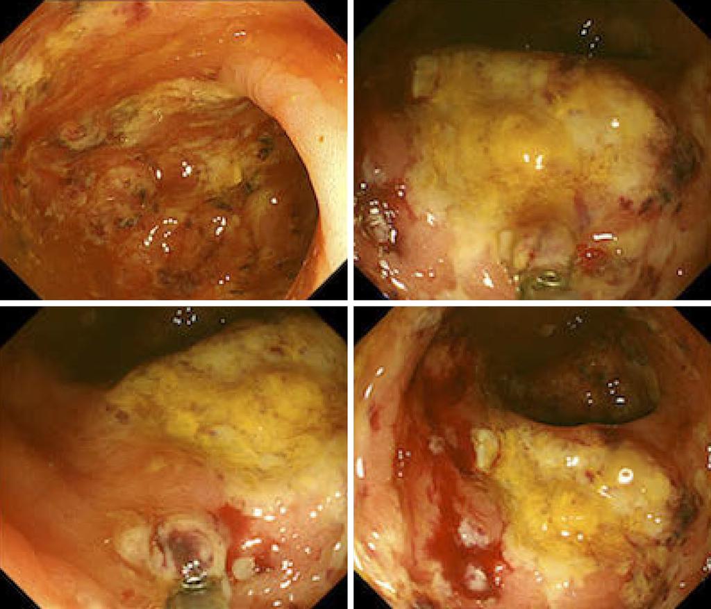 A histopathological examination of the large intestine mucosa revealed the presence of Entamoeba histolytica trophozoites, Figure 1. CT findings on admission, showing edematous changes in the colon.