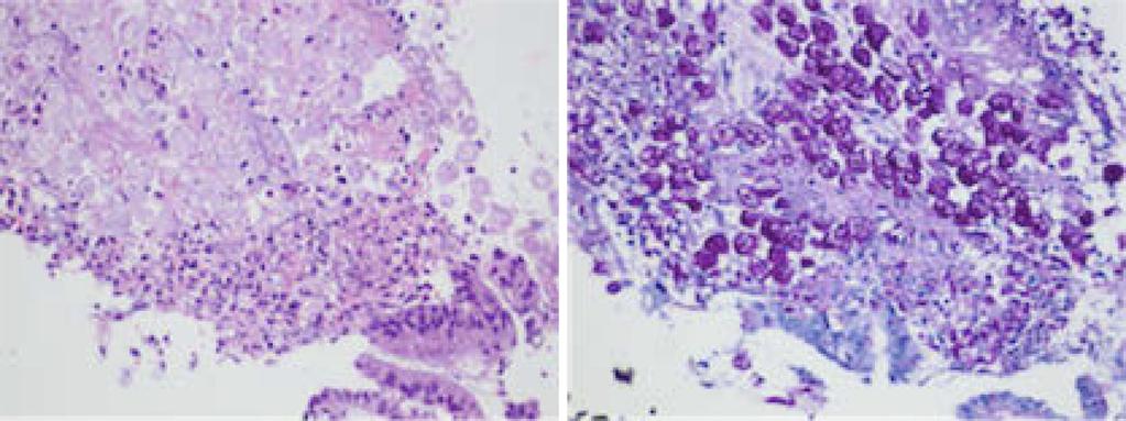 A B Figure 3. Histological findings of the sigmoid colon biopsy: A) Entamoeba histolytica trophozoites present in the mucosa (Hematoxylin and Eosin staining, 100 original magnification) and B) E.
