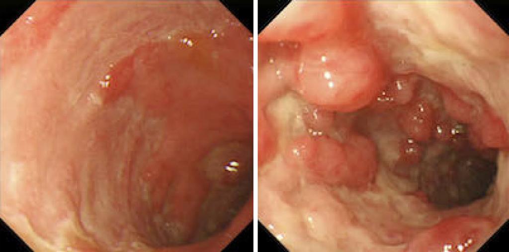 Colonoscopy performed on hospital day 20, showing extensive shallow ulcers from the sigmoid colon to the rectum, some accompanied by punched-out ulcers. from biopsies of lesion sites.