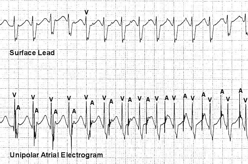 Figure 2. The surface electrocardiogram (upper tracing) reveals a regular, narrow complex rhythm with possible atrioventricular (AV) disassociation.