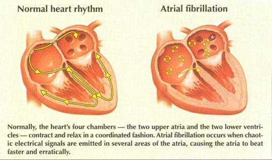 Atrial Conduction Abnormalities Atrial fibrillation is a rate over 350 bpm Since the AV node delays conduction the ventricular rate is slower (80-180 bpm) Hot spots in the atrial muscle or pulmonary