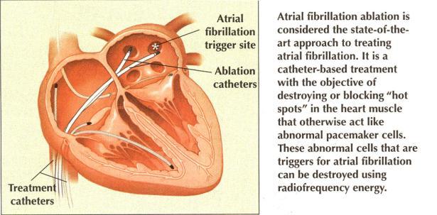 Radiofrequency energy used to treat atrial fibrillaiton AV node Abnormalities Heart block occurs when conduction is excessively