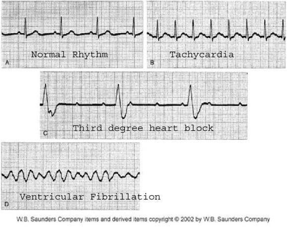 output because of reduced filling time Ventricular Conduction Abnormalities In ventricular fibrillation, muscle fibers