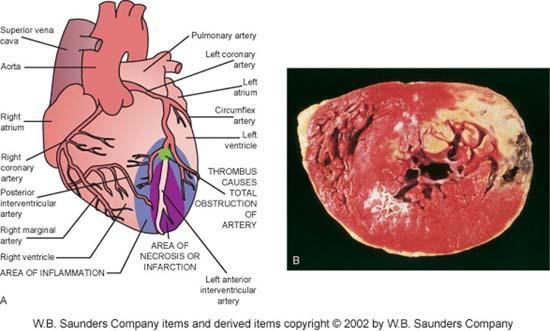 Infarction may occur in three ways: The thrombus may build up to obstruct the artery Vasospasm may occur in the presence of a partial occlusion by an atheroma leading to total obstruction Part of a