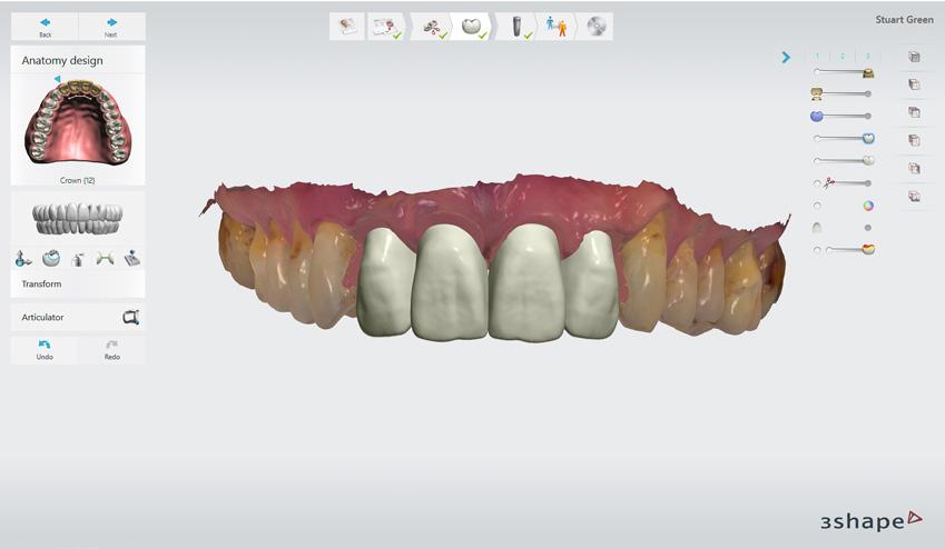 In Implant Studio, the upper incisor teeth are virtually removed and new teeth are planned.
