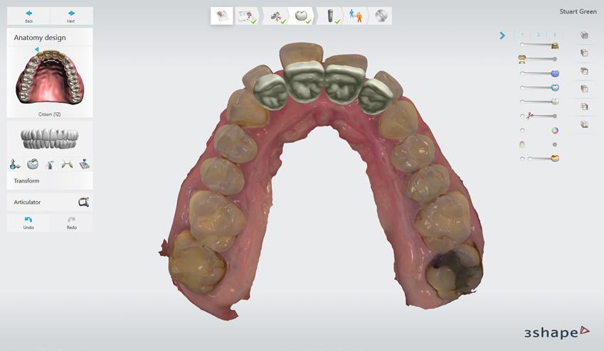 None of the standard implants were appropriate as the screw access channel would emerge through the facial surface.