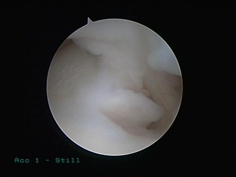 Arhtroscopy of the wrist joint: Setup, instrumentation, anatomy & indications Andreas Panagopoulos, MD,