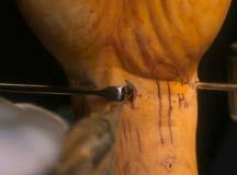 tears - 2 cm incision over the finger flexor tendons centered at the proximal