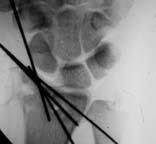 instability TFCC suture Distal radius fractures Peri-lunate dislocation