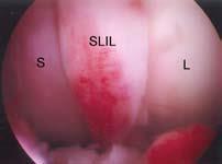 diacnostic arthroscopy ectomy procedures tissue shrinkage Scapholunate ligament reconstruction Distal radioulnar joint