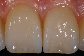 The opalescent enamel materials are perfectly suited for the free-hand layering technique and finishing of composite veneers.