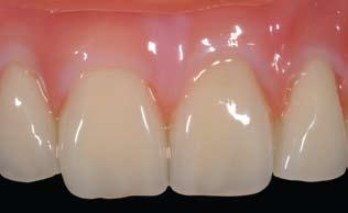 lign GUM, the layering technique can also be used in the gingival region. This way large gingival areas can be efficiently modelled on metal, zirconium and composites.