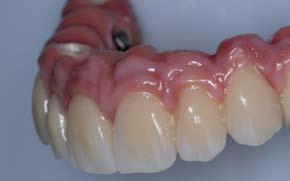 G rosa rose G light G pink M purple The different colors of the GUM materials in the visio.lign veneering system result in a lifelike appearance of the gingiva. Dott.