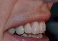 It is the key to predictable esthetic and hence to patient