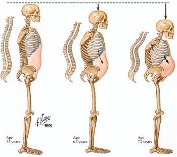 Nutritional Disorders Osteomalacia Hormonal Disorders Osteoporosis Loss of mass Bone