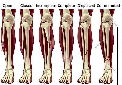 Bone Fractures Incomplete Does not cross entire