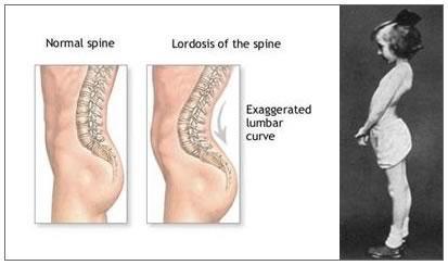 of the Spinal Column Spinous process