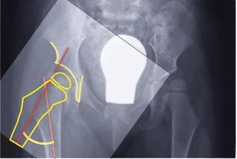 Create a blueprint of the proximal femur on the AP pelvic x-ray, rotate this blueprint around the center of the femoral head until you have a satisfactory containment.