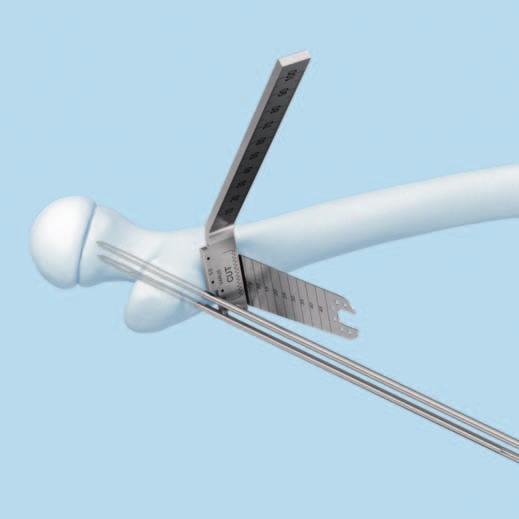 Standard Surgical Technique Osteotomy Instruments 03.108.008 Positioner for Osteotomy 1 333.060 Positioning Plate, triangular, length 45 mm, 90 /50 /40 333.