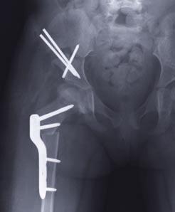 A bilateral varisation osteotomy was planned and performed with a 3.