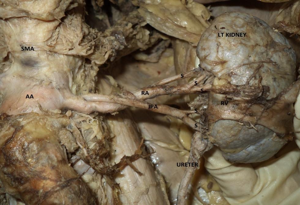 Figure 2: Left Kidney (IPA: inferior polar artery, AA: abdominal aorta, SMA: superior mesenteric