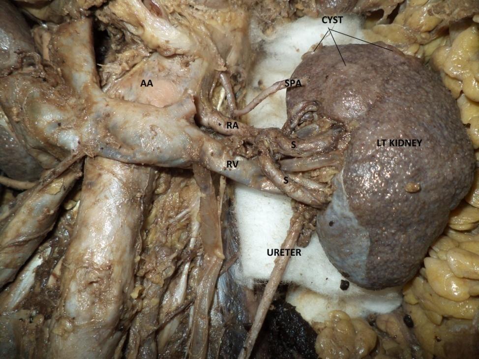 Figure 3: Left Kidney ((SPA: superior polar artery, AA: abdominal aorta, SMA: superior mesenteric
