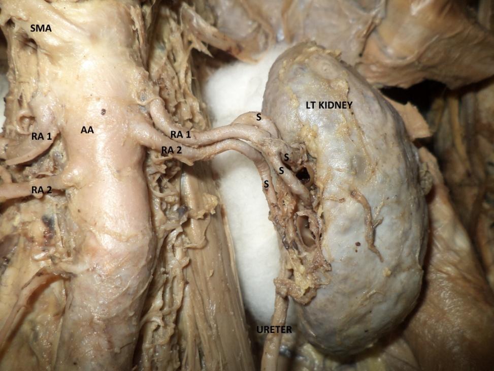 Figure 4: Left Kidney ((IPA: inferior polar artery, AA: abdominal aorta, SMA: superior mesenteric artery, S: segmental artery, LT: left, RA: renal artery) Renal artery variations including their