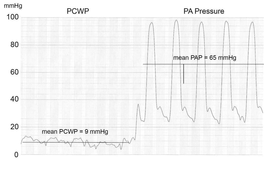 Diastolic Pressure Gradient (dpap-pcwp) Transpulmonary Gradient (mpap-pcwp) dpap =