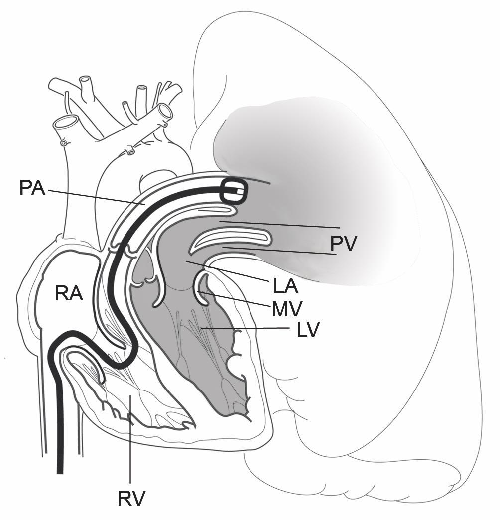 Right Heart Catheterization Window into the left heart Eberli FR in