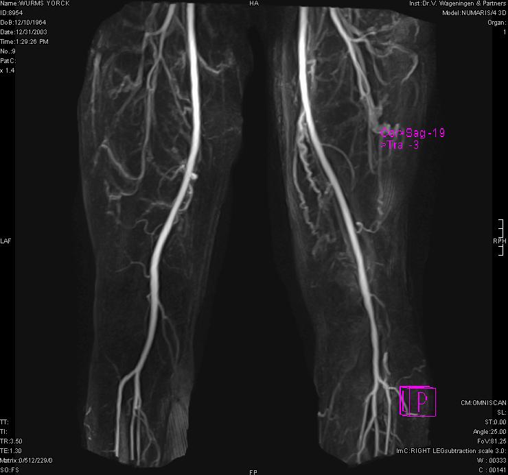 Figure 3: MR contrasted angiogram. Note narrowing of the right popliteal artery (arrow) and collaterals proximal to knee.