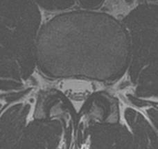 4 "At L4 5, there is minimal disc bulge and mild bilateral facet and ligamentum flavum hyptertorphy without significant central canal or neural foraminal narrowing.