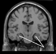 anterograde amnesia normal memory for remote events (childhood, etc) Severe deficit (global