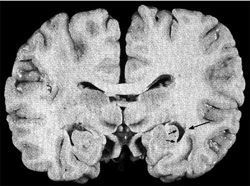 ) Normal Herpes encephalitis Alzheimer s disease: plaques & tangles in memory areas Herpes Simplex