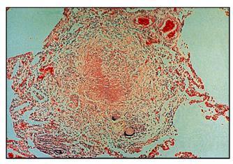 A characteristic localized inflammatory response occurs: a central core of infected macrophages (which may become