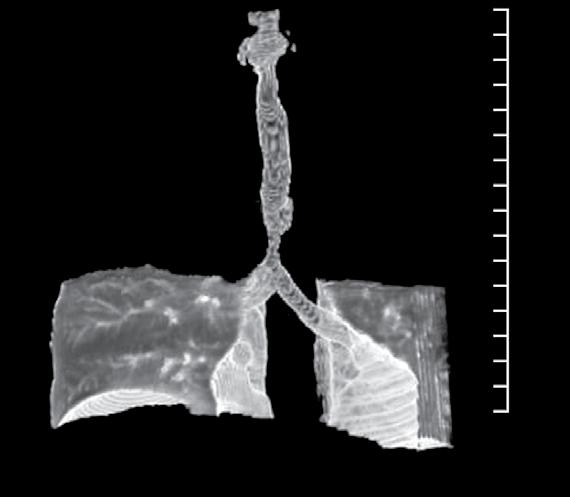 Approximately 20 mm of the distal trachea were dissected, and a primary airway anastomosis, without tension, was performed in apparently undamaged tissue.