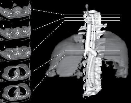 124 Leite AG, Kussler D Figure 3 - Postoperative computed tomography (CT) scan of the chest: CT of the chest (axial plane) and threedimensional reconstruction showing the tracheobronchial stent