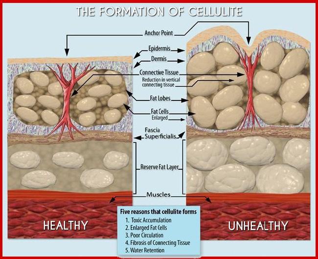 Cleansing Programs What Causes Cellulite?